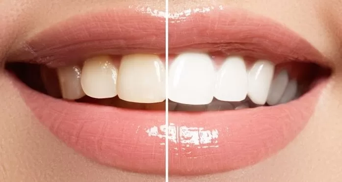 Отбеливание зубов является одним из направлений эстетической стоматологии